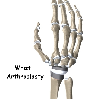 Artificial Joint Replacement of the Wrist