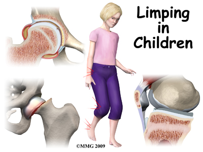 Limping in Children